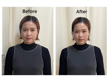 まごころ整骨院/美容鍼Before&After(１回施術）