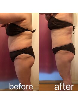 リンパケアサロン ジュビル(Jubil)/ラジオ波&キャビでサイズダウン