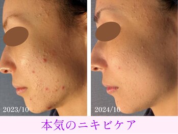 オーシャンブルー 大分店(OCEAN BLUE)/本気のニキビケア