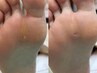 【タコ・魚の目】足裏上半分　数に限らず一律！！　￥5500