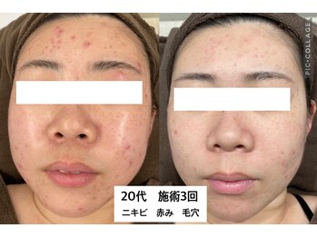 チャマ 徳島本店(CHAMA)/20代 WiQo水光ピール 施術3回