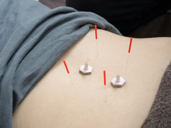 南流山鍼灸院 佑/優しい鍼灸施術