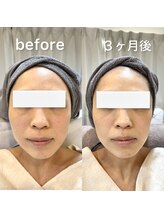 レミュービューティー(Remieux beauty)/before/after