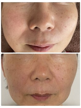 エステティックセラピー プレマ(PREMA)/筋膜&脂肪ケアで輪郭も変わる♪