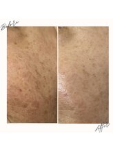 イチロクイチハチ(1618)/美容液導入だけでこの変化