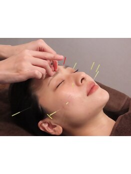 鍼灸施術を受けたい