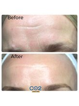 ウィズリリナ 新横浜(with Lilina.)/1回/カーボキシー/炭酸パック