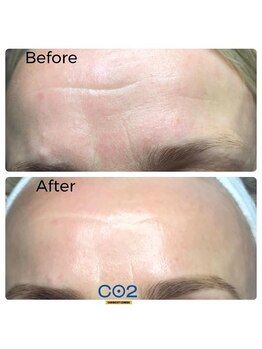 ウィズリリナ 新横浜(with Lilina.)/1回/カーボキシー/炭酸パック