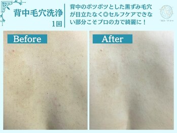 フローフシ∞/【背中毛穴洗浄】毛穴黒ずみ改善
