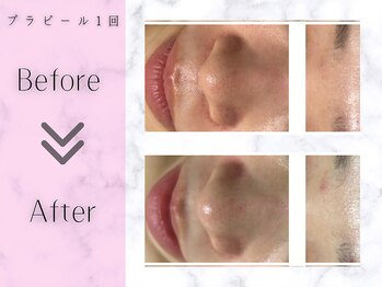 リライフ(ReLIFE)/韓国肌管理/毛穴洗浄+ララピール