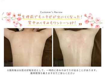 ブリス 渋谷駅前(BliSS)/ハーブピーリング|生理前ニキビ