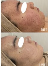 ミセル(MISEL2nd)/ニキビケア/肌質改善もお任せ♪