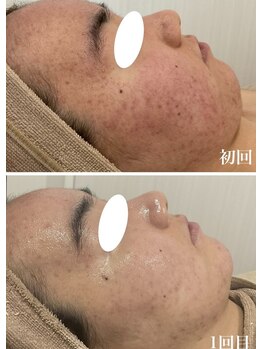 ミセル(MISEL2nd)/ニキビケア/肌質改善もお任せ♪