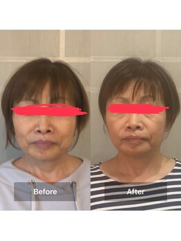 ヨサ パーク コアハート(YOSA PARK CORE HEART)/YOSAで浮腫スッキリ