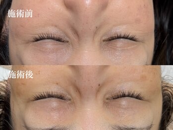 キーオブフェイス(Key of Face)/お悩み【目元の小じわ】