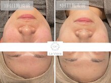 ラヴィオーラ 加古川店(La Viora)/ダイヤモンドハーブピーリング