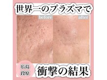 エミュローズ 段原店(Nm' Rose)/本格的な肌質改善
