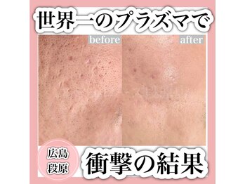 エミュローズ 段原店(Nm' Rose)/本格的な肌質改善