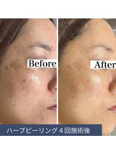 エルア 尼崎(Elua)/繰り返すシミ