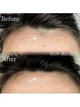 サロンロン 横浜関内(SALON RON)/額の脱毛/美容電気脱毛