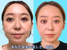 ナチュラルビューティーフェイス 横浜(NBF)/ビフォーアフター写真
