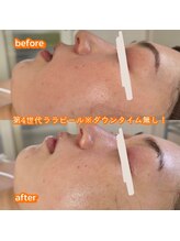 エムアイ 六本木(Mi)/ララピールで肌育！