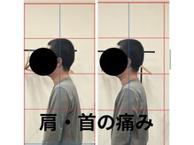 カワル整体 長嶺院/肩・首の痛み