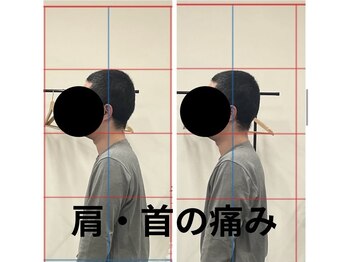 カワル整体 長嶺院/肩・首の痛み