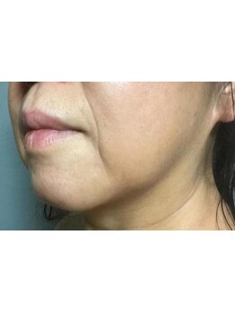 ホウレイ線・たるみ改善！予防ケア