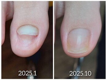 【足爪育成】欠損爪も育成します