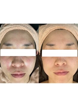 ネムレル森(Nemureru森)/毛穴洗浄【水巻/八幡西区/折尾】