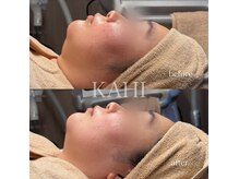 カヒ 札幌駅前(KAHI)の雰囲気（圧倒的症例数！！ 40代女性｜マイクロウェーブリフト1回施術症例）