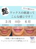 【男性クーポン】フェイシャルWAX+光脱毛(高濃度パック付) ¥24,750→¥19,800