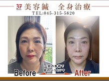 韓国式美容鍼 TAKAHANA