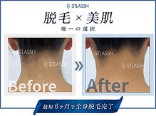 ストラッシュ 静岡店(STLASSH)/メニュー：全身脱毛（うなじ）