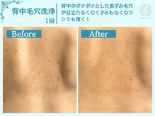 フローフシ∞/【背中毛穴洗浄】毛穴黒ずみ改善