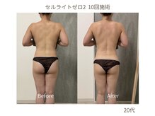 アンベリル(Embellir)/痩身ビフォーアフター