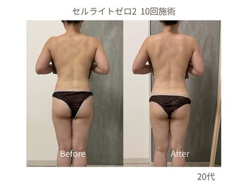 アンベリル(Embellir)/痩身ビフォーアフター