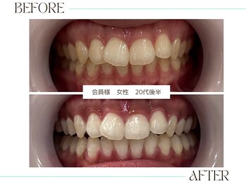 ホワイトニングサロンブライト 尼崎店(Whitening salon bright)/セルフホワイトニング 女性