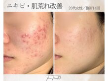 スリースリー 恵比寿(THREE THREE)/ニキビ・肌荒れケア