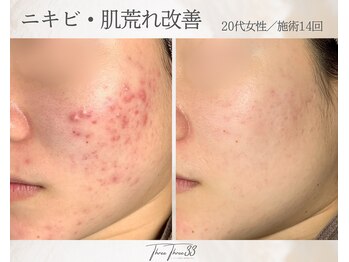 スリースリー 恵比寿(THREE THREE)/ニキビ・肌荒れケア
