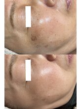 クレアナ ザ ビューティー(KULEANA the beauty)/光フォト