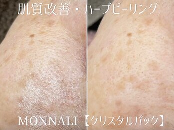 シュアショット(SURE SHOT)/ハーブピーリング