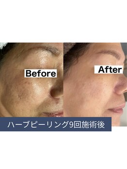 エルア 尼崎(Elua)/最強の肌質改善