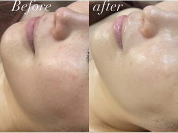 レシェルサロン(Lechelle Salon)/ダーマエステ幹細胞フェイシャル