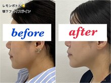 アモーラ(Amora)/レモンボトル顎下