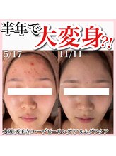 アルムダアクア 天王寺店(Aleumda AQUA)/ハーブピーリング/大阪/天王寺