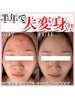 アルムダアクア 天王寺店(Aleumda AQUA)/ハーブピーリング/大阪/天王寺