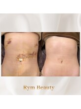 リム ビューティー(RYM BEAUTY)/インディバボディ