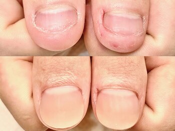 ネイルサロン オー(Oh!)/劇 的☆深爪改善！before→after